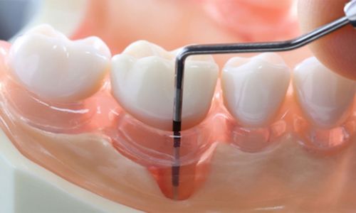 Mirage Dental Clinic | Periodontics