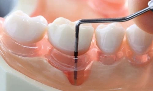 Mirage Dental Clinic | Periodontics